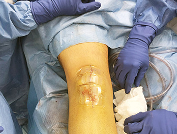 Wound Closure