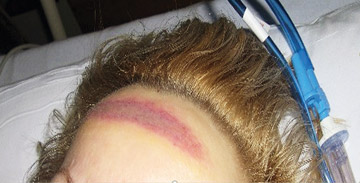 Pressure Injury