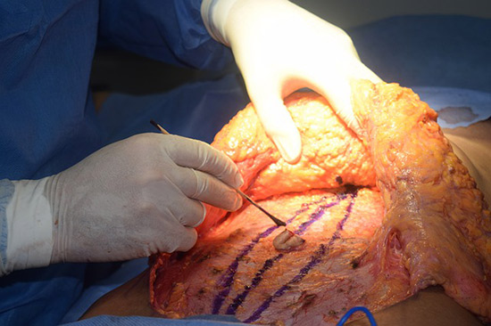 Tummy Tuck