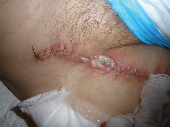 Wound