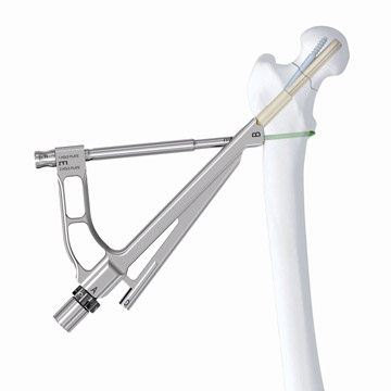 Implant for Femoral Neck Fracture\s