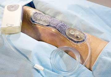 Prevena Incision Management Sys\tem 