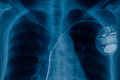Chest X-ray image showing a pacemaker in place