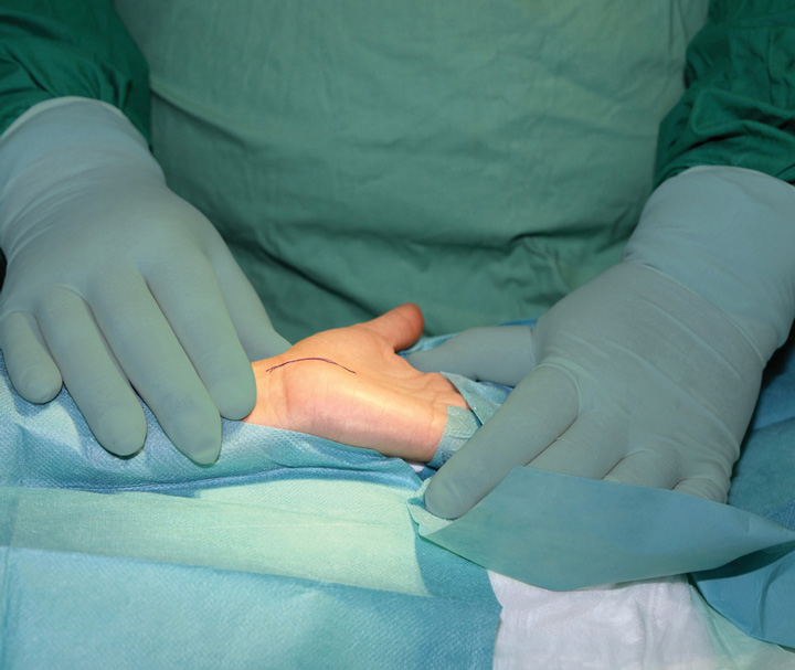 Endoscopic CRT