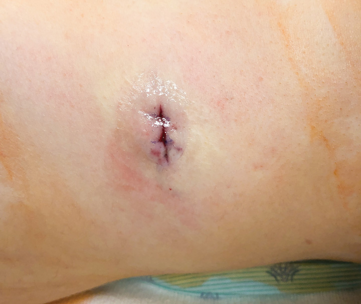 wound