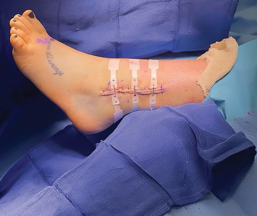 Incision after closure of the wound and application of surgical glue