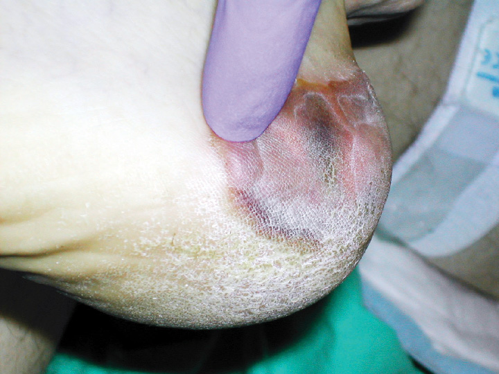 Heel Ulcer