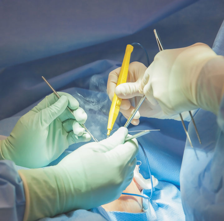 Surgical smoke