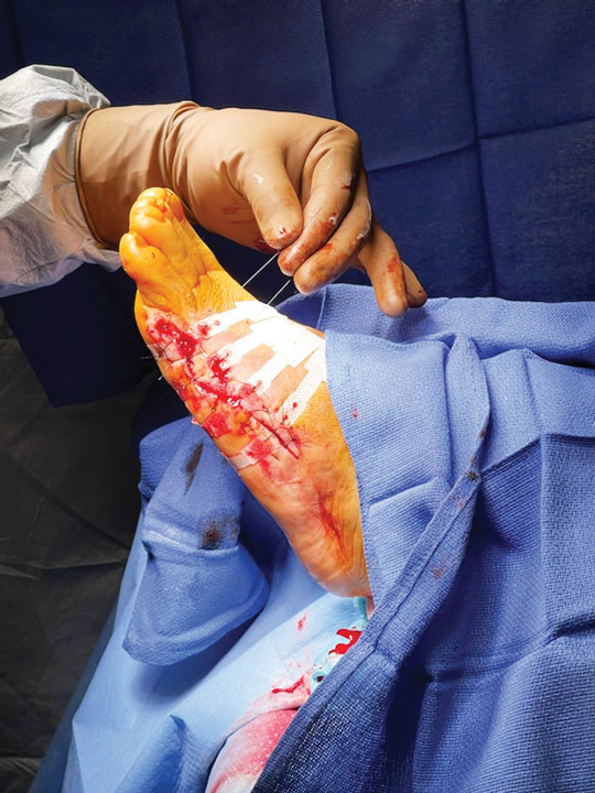 intraop closure