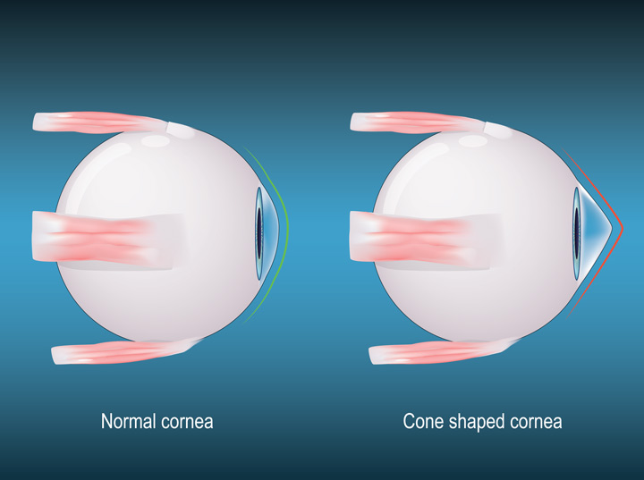 cornea