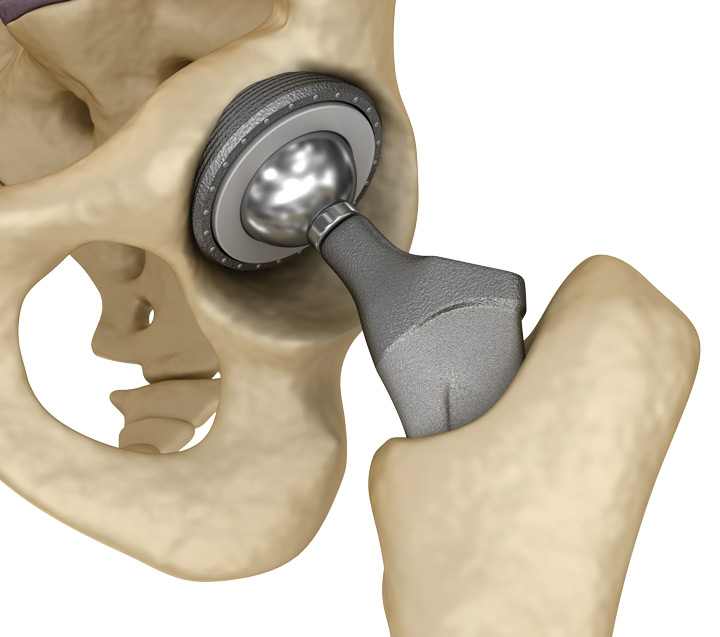 Hip Implant